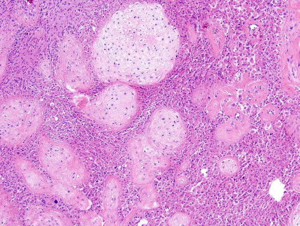 17A3 Glioblastoma, cartilage (Case 17) H&E 7.jpg