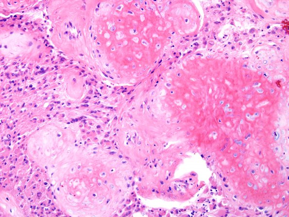 17A5 Glioblastoma, cartilage (Case 17) H&E 1.jpg