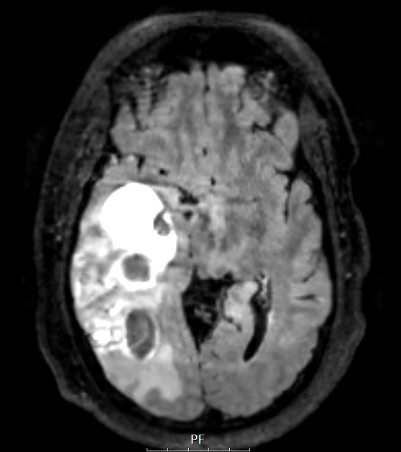 19A1 GBM with Adenoid (Case 19) FLAIRW A - Copy