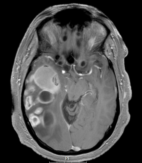 19A3 GBM with Adenoid (Case 19) T1W A - Copy
