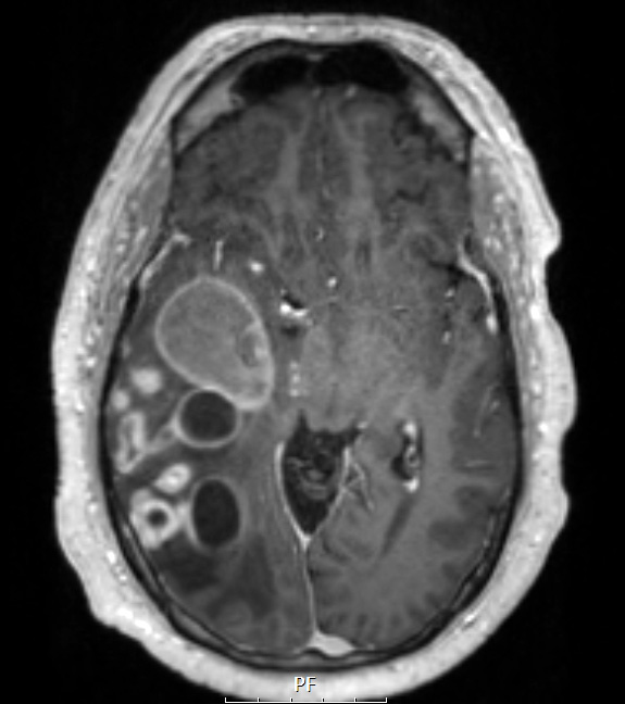 19A4 GBM with Adenoid (Case 19) T1PostContrast A - Copy