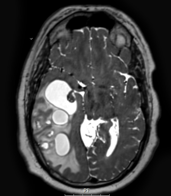 19A5 GBM with Adenoid (Case 19) T2W A - Copy