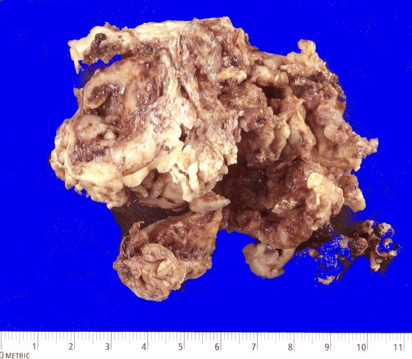 19B2 GBM with Adenoid (Case 19) Gross _2