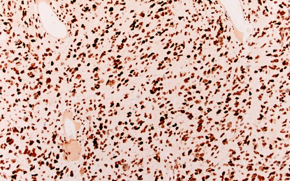 19F2 GBM with Adenoid (Case 19) A5 ATRX 20X