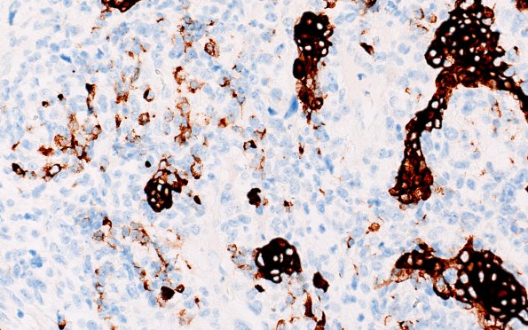 19L2 GBM with Adenoid (Case 19) B4 CAM5.2 40X