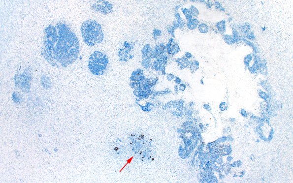 19T1 GBM with Adenoid (Case 19) A3 CAM5