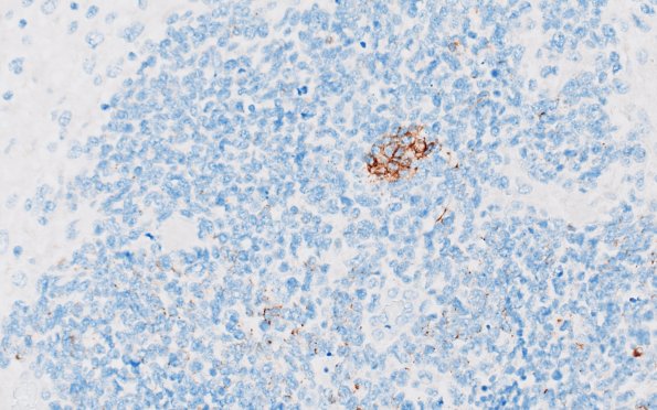 19T5 GBM with Adenoid (Case 19) A3 CAM5.2 40X