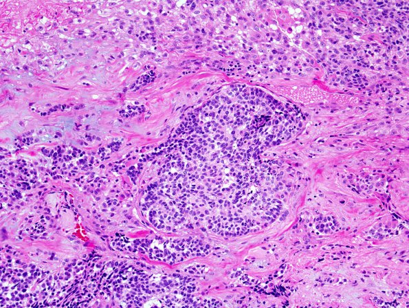 1A1 GBM, adenoid features (Case 1) H&E 2.jpg