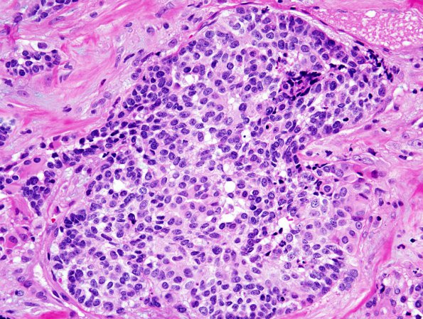 1A2 GBM, adenoid features (Case 1) H&E 3.jpg