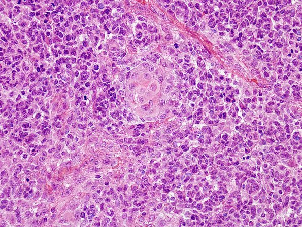 1A6 GBM, Adenoid (Case 1) H&E 8