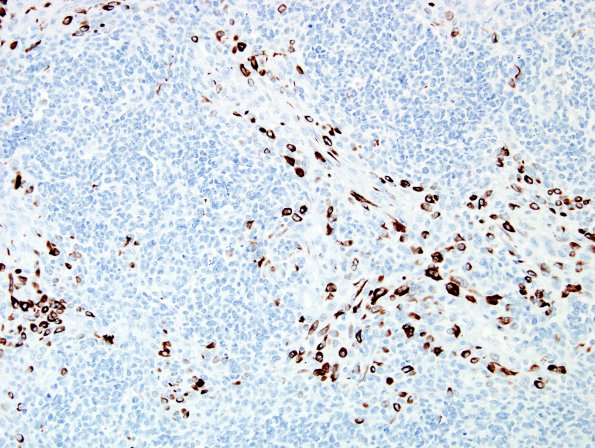 1B3 GBM & Adenoid (Case 1) GFAP 5