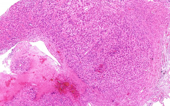 2A1 Glioblastoma, adenoid (Case 2) H&E 4X