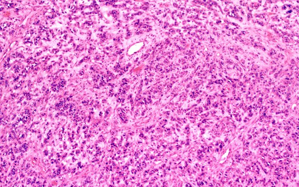 2A2 Glioblastoma, adenoid (Case 2) H&E 10X