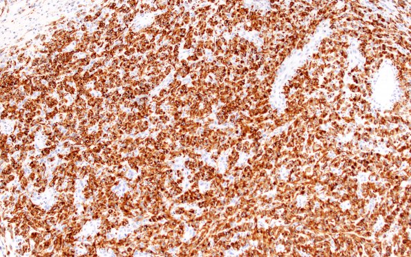 2C1 Glioblastoma, adenoid (Case 2) GFAP 10X