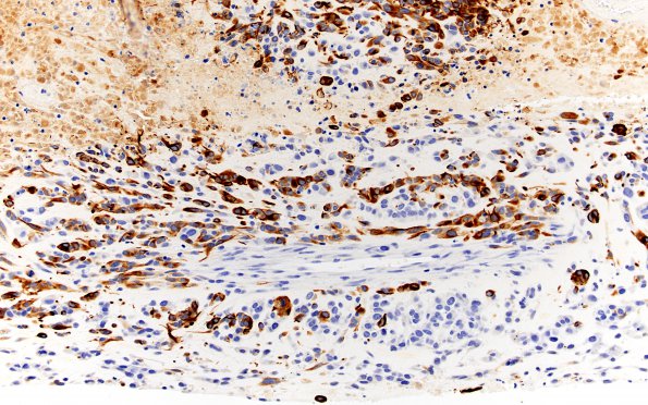 2C3 Glioblastoma, adenoid (Case 2) GFAP 20X 3