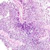 3A1 GBM, Adenoid (Case 3) H&E 7