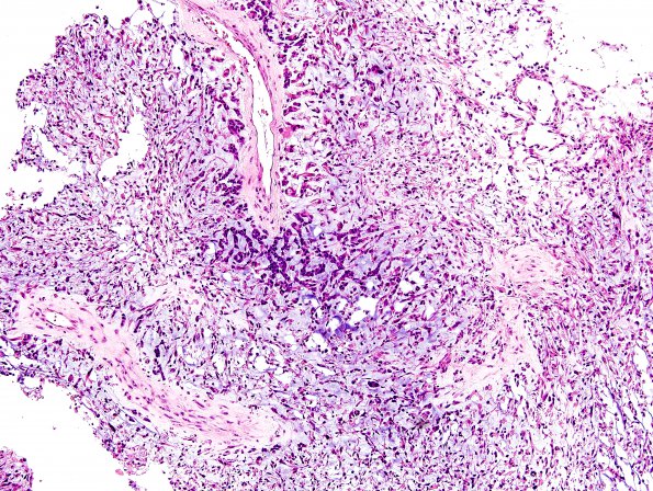 3A1 GBM, Adenoid (Case 3) H&E 7