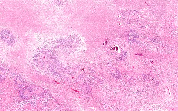 4A1 Glioblastoma, adenoid (Case 4) H&E 4X