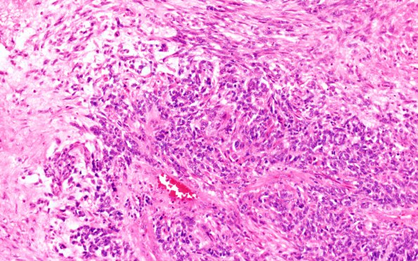 4A2 Glioblastoma, adenoid (Case 4) H&E 20X