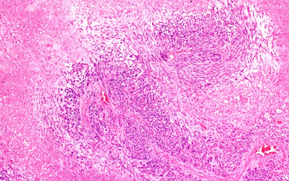 4A3 Glioblastoma, adenoid (Case 4) H&E 10X