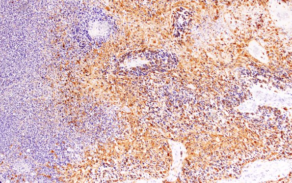 4B1 Glioblastoma, adenoid (Case 4) GFAP 10X