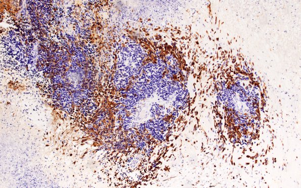 4B2 Glioblastoma, adenoid (Case 4) GFAP 10X 2