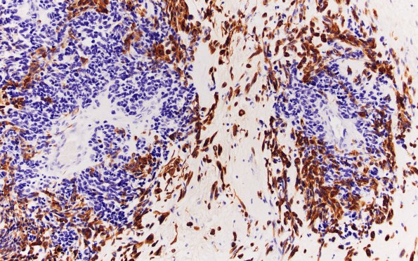 4B4 Glioblastoma, adenoid (Case 4) GFAP 20X 2