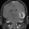 5A GBM with Adenoid features (Case 5) T1 W - Copy