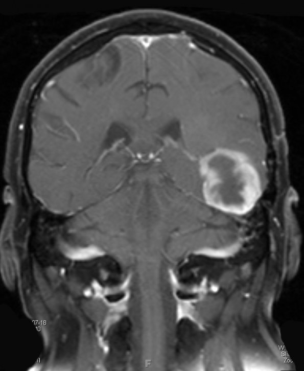 5A GBM with Adenoid features (Case 5) T1 W - Copy