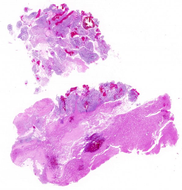 5B1 GBM with Adenoid features (Case 5) H&E WM