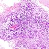 5B3 GBM with Adenoid features (Case 5) H&E 2.jpg