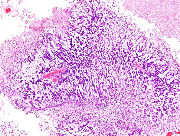 5B3 GBM with Adenoid features (Case 5) H&E 2.jpg