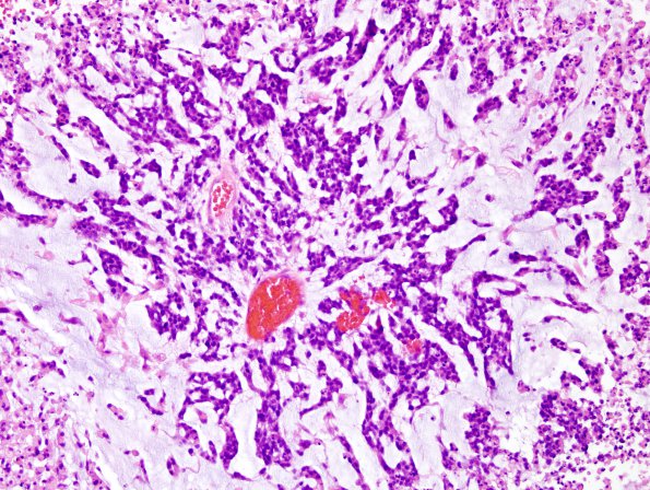 5B4 GBM with Adenoid features (Case 5) H&E 3.jpg