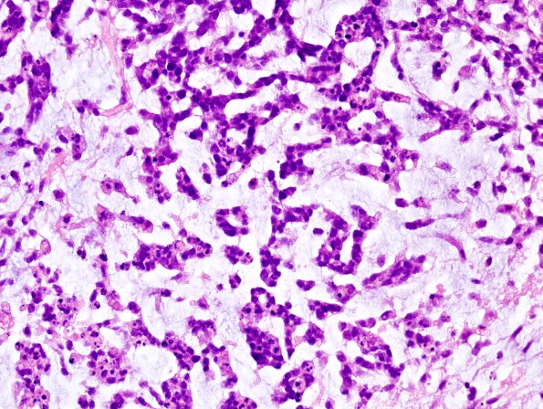 5B5 GBM with Adenoid features (Case 5) H&E 4.jpg