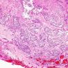 6A1 GBM, Adenoid Features (Case 6) H&E 4