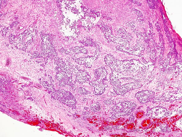 6A1 GBM, Adenoid Features (Case 6) H&E 4