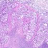 8A2 GBM, adenoid (epithelioid) form (AANP 1990, Case 6) H&E X4 2