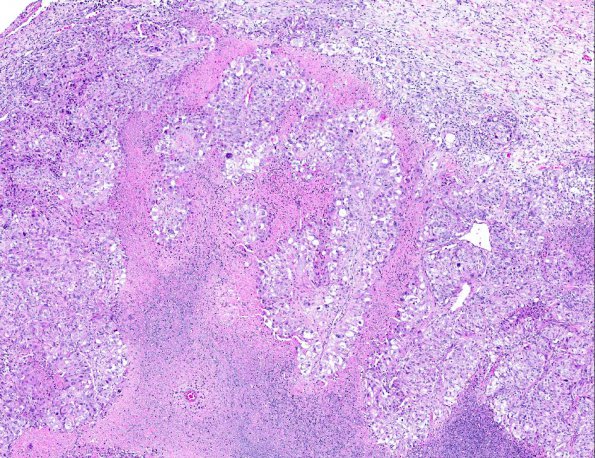 8A2 GBM, adenoid (epithelioid) form (AANP 1990, Case 6) H&E X4 2