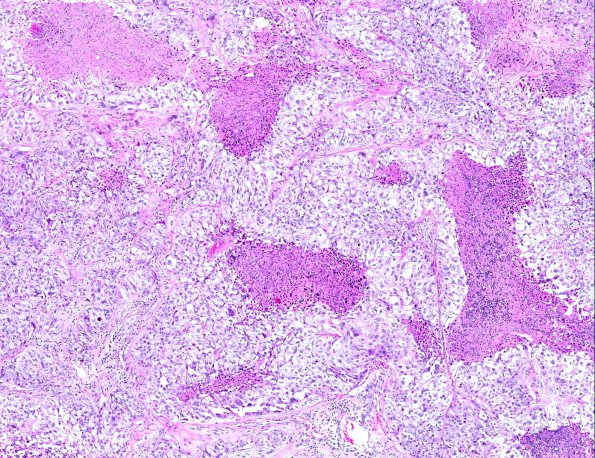 8A3 GBM, adenoid (epithelioid) form (AANP 1990, Case 6) H&E X5 2