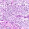 8A4 GBM, adenoid (epithelioid) form (AANP 1990, Case 6) H&E X10 2