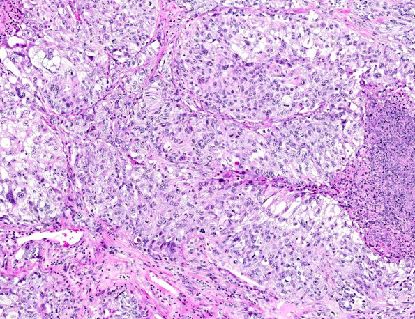 8A4 GBM, adenoid (epithelioid) form (AANP 1990, Case 6) H&E X10 2