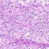 8A5 GBM, adenoid (epithelioid) form (AANP 1990, Case 6) H&E X20 2