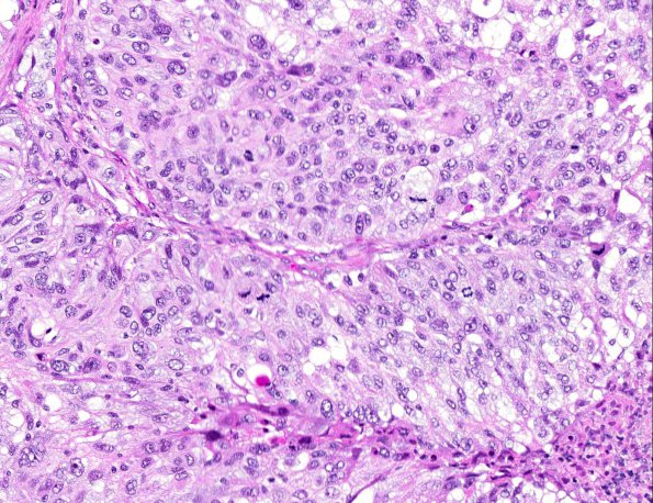 8A5 GBM, adenoid (epithelioid) form (AANP 1990, Case 6) H&E X20 2