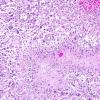 8A6 GBM, adenoid (epithelioid) form (AANP 1990, Case 6) H&E X10 4