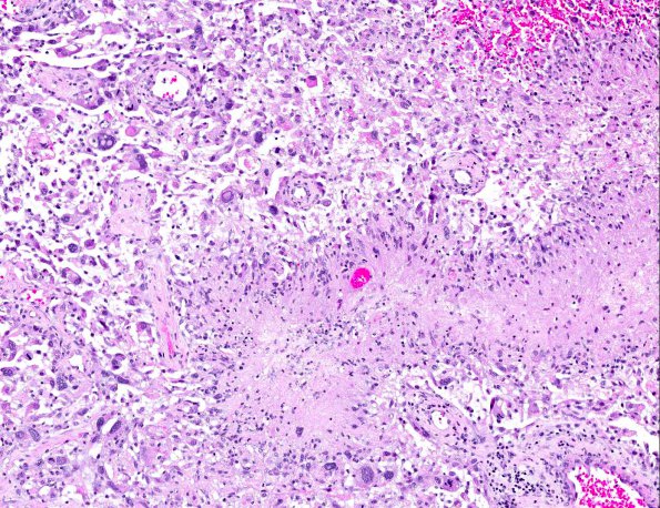 8A6 GBM, adenoid (epithelioid) form (AANP 1990, Case 6) H&E X10 4