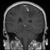 9A GBM, Adenoid  (Case 9) MRI - Copy