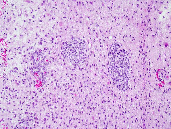 9B1 GBM, Adenoid (Case 9) H&E 1.jpg