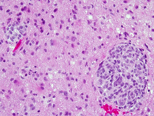 9B2 GBM, Adenoid (Case 9) H&E 4.jpg