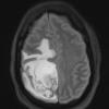 1A1 GBM, Epithelioid (Case 1) FLAIR - Copy