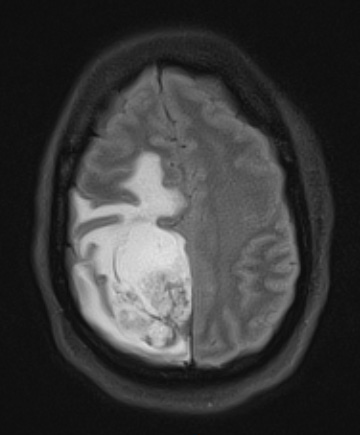 1A1 GBM, Epithelioid (Case 1) FLAIR - Copy